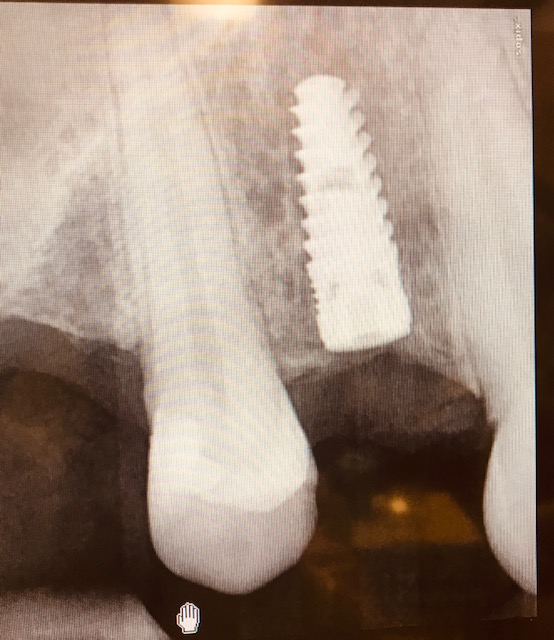 Dental Implants Dentist in Wethersfield