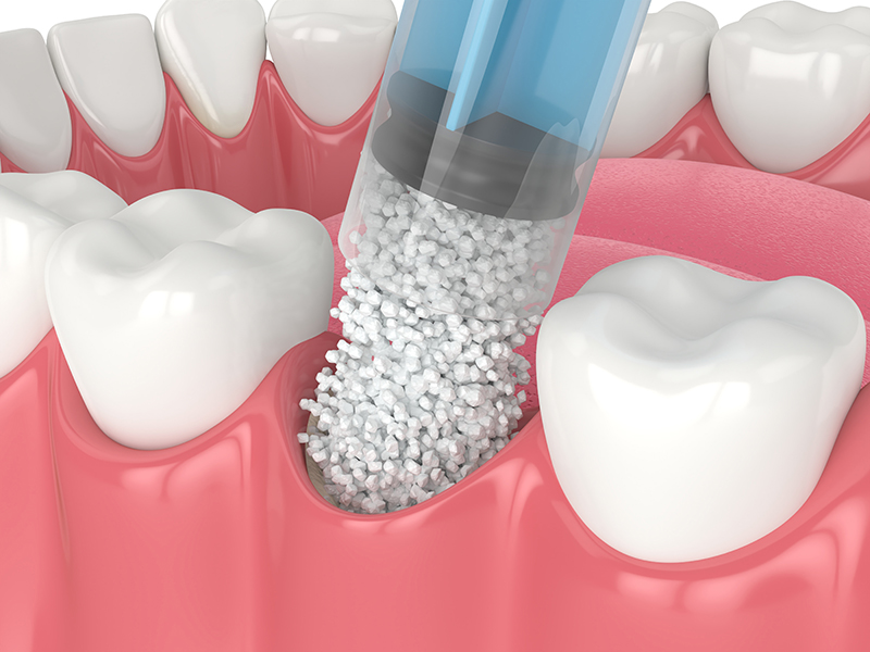 Dental Implant Restorations Wethersfield